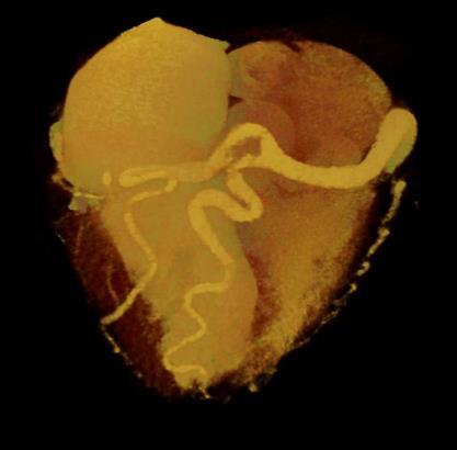 Si preferiscono modalità di riparazione con sistema a doppia coronaria sono che comprende il reimpianto coronarico (procedura di Takeuchi ) o e il posizionamento di un bypass coronarico con legatura