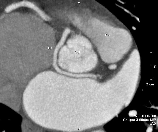 (AO-aorta; TC-tronco comune; A POLM-arteria polmonare; ACDX-arteria coronarica destra).