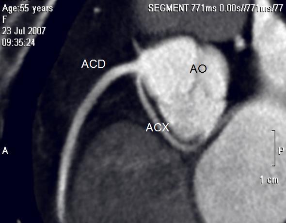 Origine anomala dell'arteria circonflessa dal seno di Valsalva destro E' una delle anomalie più comuni (Fig 12). Questa condizione può essere trovata in circa 0,32-0,67% della popolazione [43].