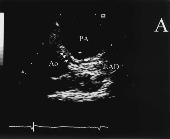 Figura 16: Ecocardiografia transtoracica in asse corto, in un paziente con origine anomala della coronaria sinistra dal seno di Valsalva destro e un decorso intramurale della coronaria anomala.