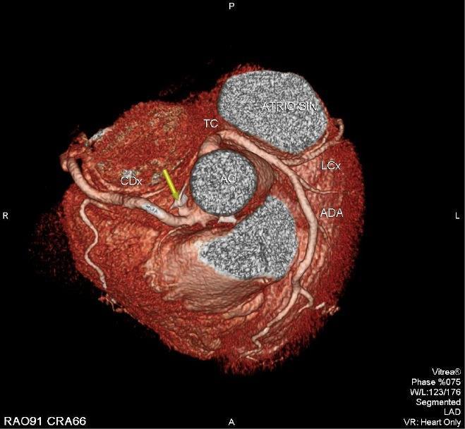 La scintigrafia da sforzo ha evidenziato difetto circoscritto in sede infero-basale e la PET cardiaca lieve riduzione relativa della riserva coronarica nel territorio della DA.