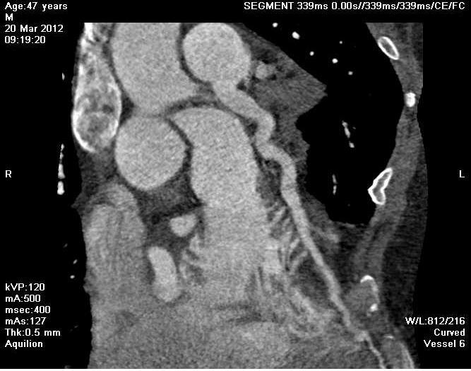 incannulazione della coronaria con cateteri guida con conseguente impossibilità ad eseguire misurazioni funzionali.