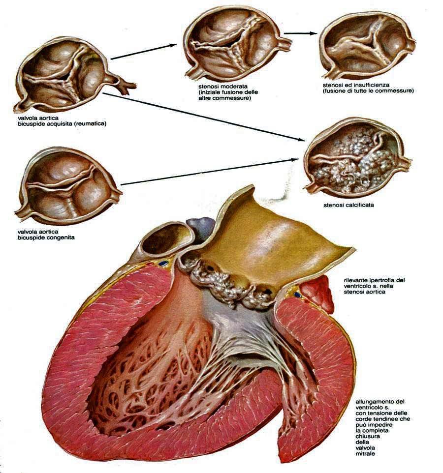 1.3. Morfologia e Fisiopatologia della stenosi aortica degenerativa.