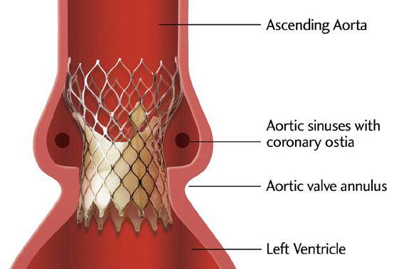 Figura -13- Rappresentazione grafica della protesi in sede aortica: nella figura possiamo osservare la posizione che assume la valvola una volta rilasciata in sede.