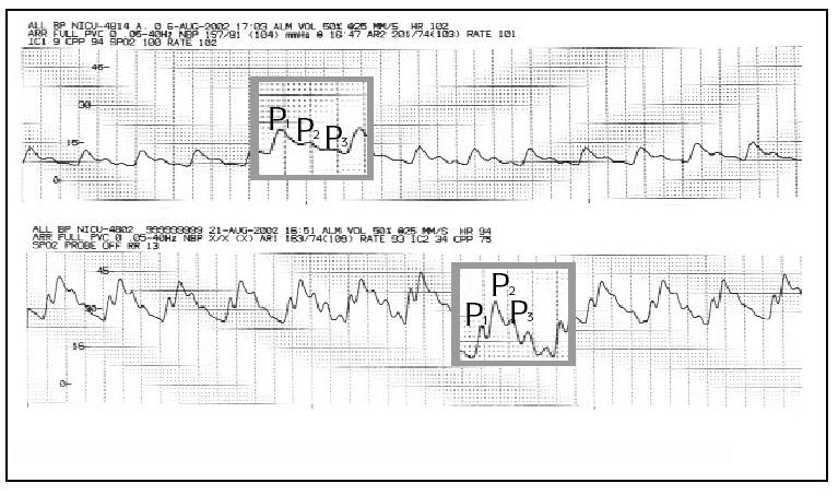 La pressione intracranica 14 istantaneo della pressione intracranica può variare fino a 4mmHg a causa dell attività cardiaca e fino a 10mmHg a causa della respirazione. In figura 1.