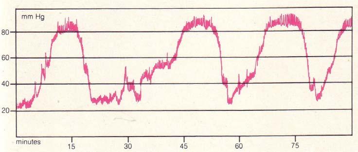 La pressione intracranica 15 Figura 1.4: onda A o onda plateau Se le onde A sono continue possono indicare un danno cerebrale irreversibile. Onda B (v. figura 1.