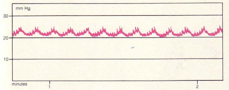 La pressione intracranica 16 Figura 1.6: onda C In tabella 1.1 sono riassunti i principali parametri delle forme d onda legate alla pressione intracranica.