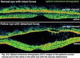 Coherence Tomography