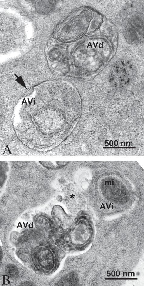 Vacuoli autofagici visq al TEM ADraverso la microscopia elehronica è possibile seguire la stadiazione dei vacuoli autofagici.