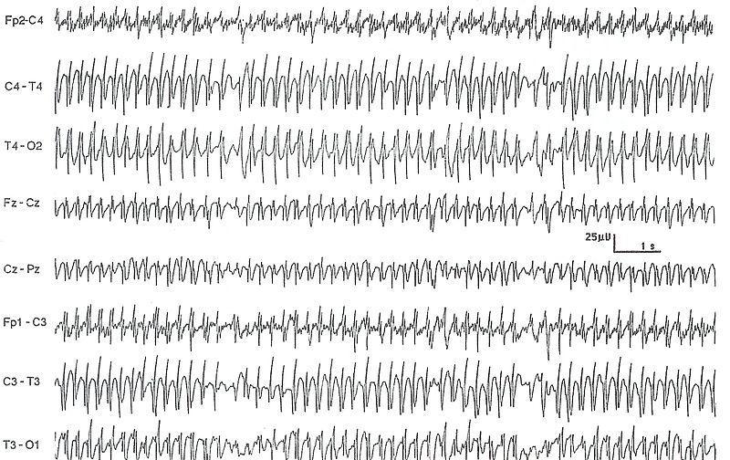 una perdita del controllo inibitorio normale un ipersensibilità chimica che accresce l eccitabilità neuronica L origine delle crisi epilettiche è stata definita all inizio del XIX secolo dal