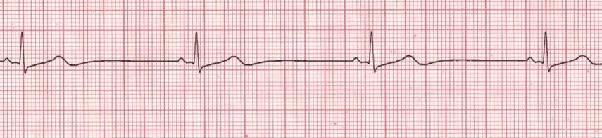 BRADICARDIA: Diminuzione di frequenza del battito cardiaco al di sotto del valore normale, che è di circa 70 battiti al minuto.