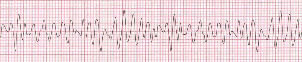 FIBRILLAZIONE VENTRICOLARE: Attività del cuore totalmente irregolare, supera i 300 battiti al minuto.