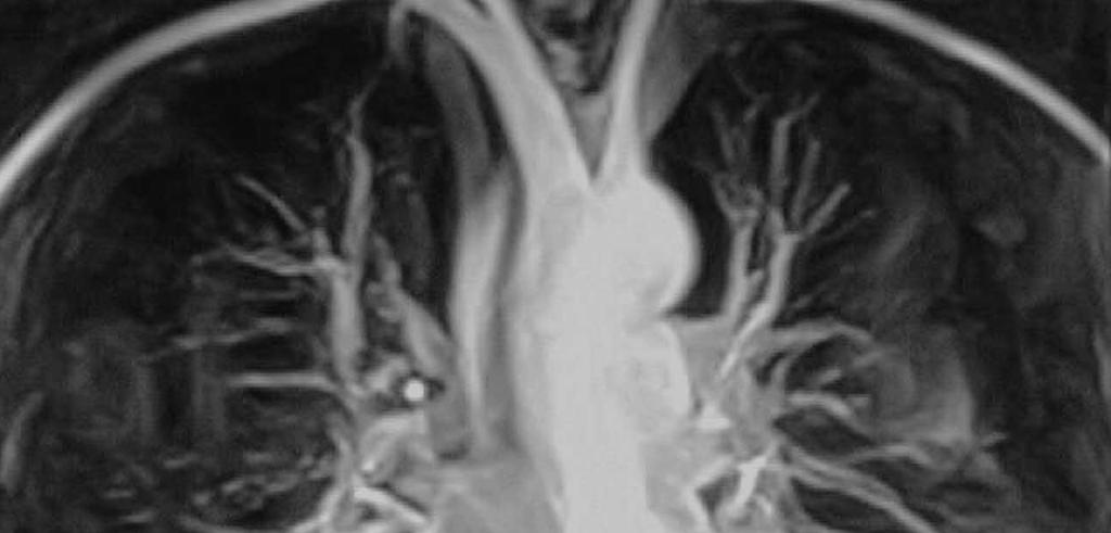 Il circolo polmonare L arteria polmonare nasce dal ventricolo destro e si ramifica in