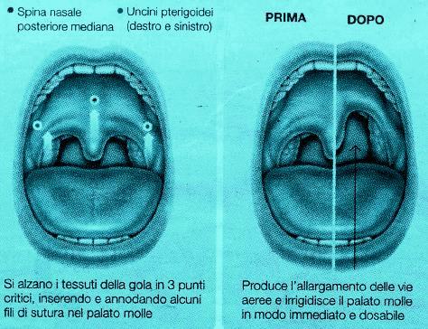 Questa breve scheda informativa ha lo scopo di illustrare come l intervento chirurgico Barbed Snore Surgery (BSS) sia utile nel trattamento del russamento e delle apnee nel sonno.