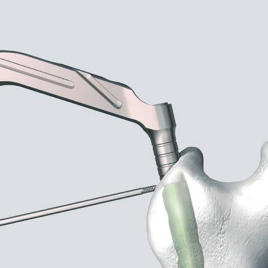 La punta del filo guida indica l esatta posizione prossimale del chiodo. Controllare la posizione finale del chiodo con l amplificatore di brillanza sul piano AP e laterale.