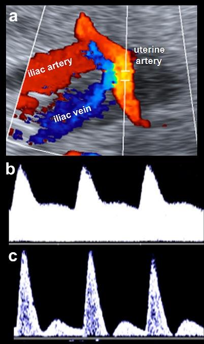 Doppler uterino a 20 wks Circolazione placentare ad alta