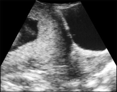 Placenta Valutazione della localizzazione placentare per via transaddminale