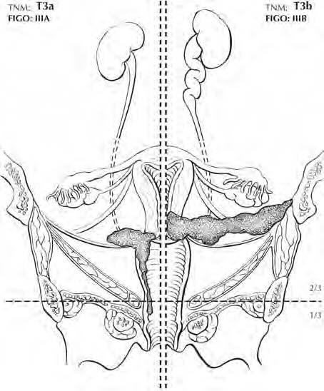 28 FIGURA 28.10. Il tumore T3 si estende alla parete pelvica e/o coinvolge il terzo inferiore della vagina e/o causa idronefrosi o rene non funzionante.