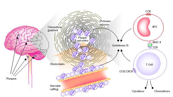 In particolare nella Sclerosi Multipla le placche (che si evidenziano con la risonanza magnetica )sono caratterizzate da un cuffing perivascolare al cui epicentro della zona infiammatoria un