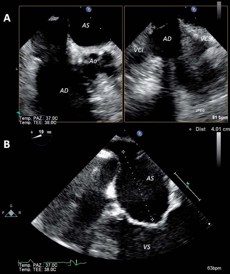 La procedura viene solitamente eseguita in sala di emodinamica standard o in sala ibrida, sotto monitoraggio fluoroscopico ed ecocardiografico transesofageo (ETE) in anestesia generale, anche se un