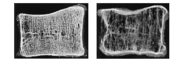 - ALGODISTROFIA La sindrome neuroalgodistrofica (altrimenti