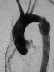 Emorragia EMOTORACE: lesioni vascolari 90-98% lesione all istmo aortico (zona più fragile)