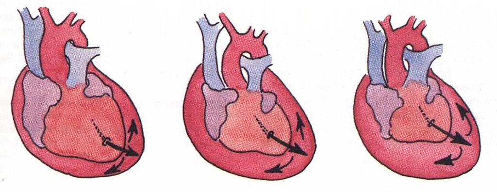 Trauma cardiaco TAMPONAMENTO CARDIACO Ipotensione arteriosa