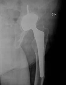 1) CASO N 1: Donna di 68 anni, portatrice da 2 anni di artroprotesi totale dell anca