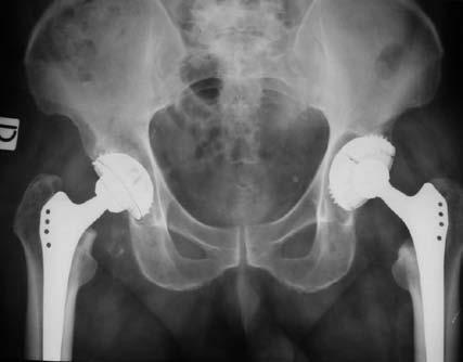 A distanza di 6 mesi si è proceduto alla protesizzazione dell anca controlaterale (fig.