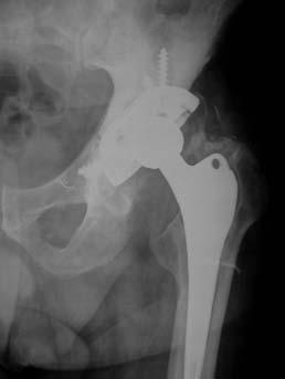 CASO N 4: Uomo di 63 anni protesizzato d anca in altra sede 4 mesi prima, si