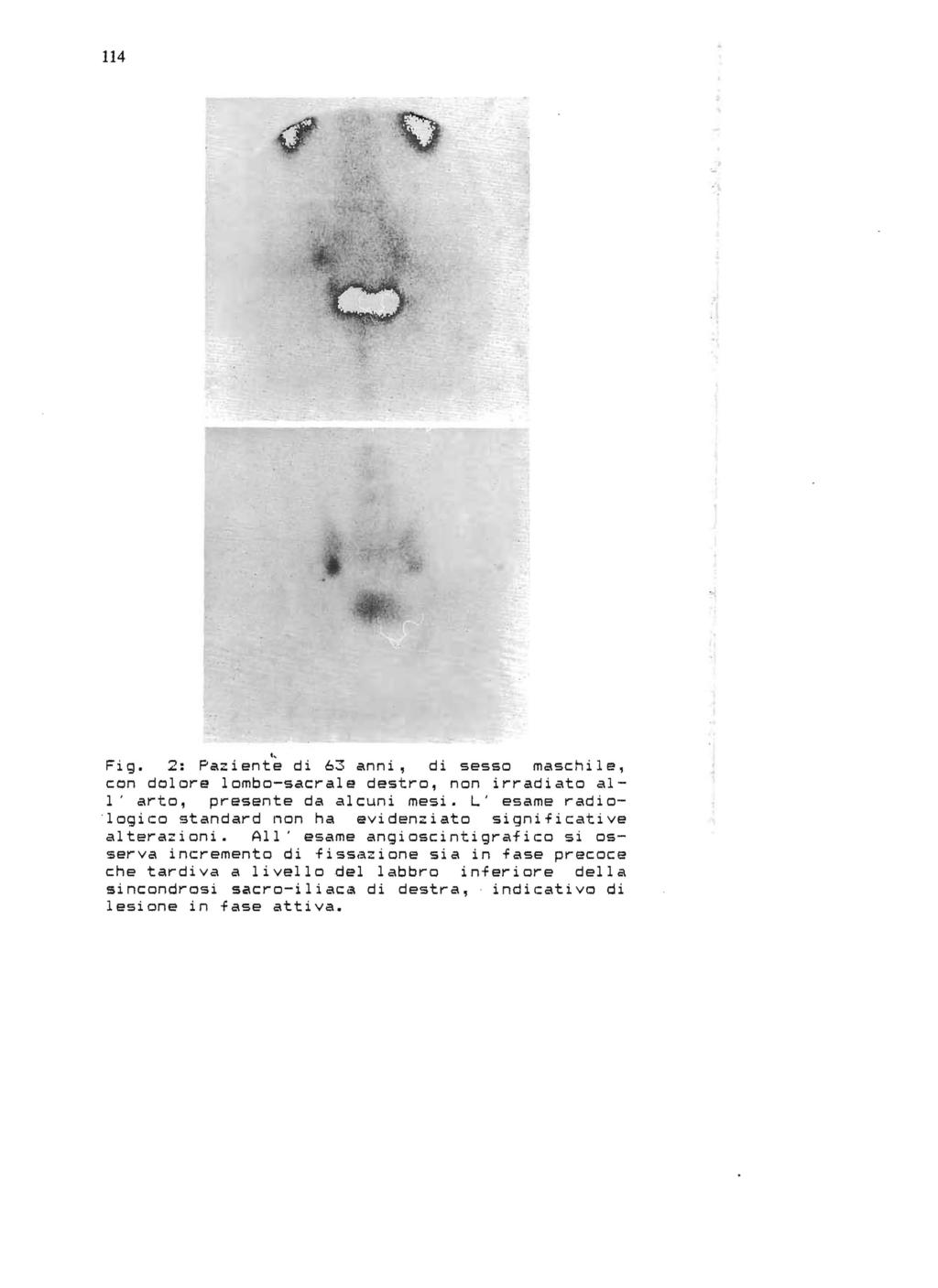 114 Fig. 2: Paziente " di 63 anni, di sesso maschile, con dolore lombo-sacrale destro, non irradiato all ' arto, presente da alcuni mesi.