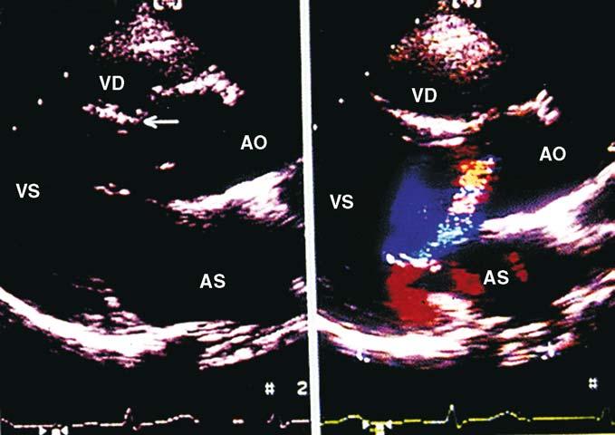 92 Cardiopatie congenite Figura 9.2 Difetto del setto interventricolare (DIV) con una cuspide aortica che prolassa e un insufficienza aortica secondaria. Sezione ecocardiografica lungo assiale.