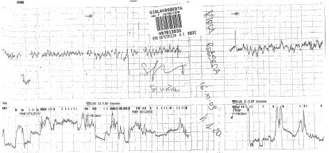 Il monitoraggio riportato evidenzia una prima decelerazione variabile alle ore 00:09 con nadir tra 80 e 90 bpm seguita alle ore 00:17 da una prima decelerazione variabile severissima, di durata di