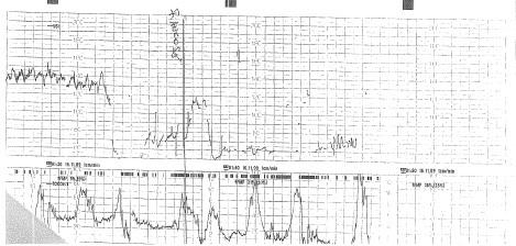 00:30 un ulteriore decelerazione variabile della durata di circa due minuti con nadir di 100 bpm, lento recupero e variabilità ridotta a 5 bpm.