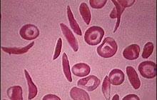 Anemia in Celiac Disease ANEMIA IN MALATTIA CELIACA 5-8% di adulti con