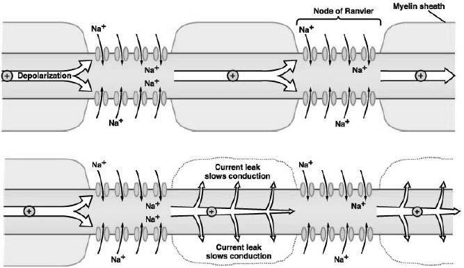 Conseguenze neurofisiologiche della demielinizzazione