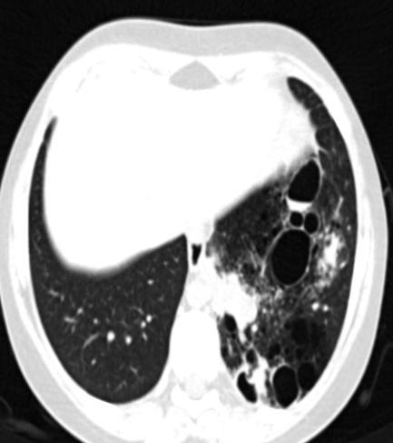 adulta di trasformazione neoplastica della lesione Fig 3 Quadro Rx di addensamento basale sn da infezione polmonare in pz con CPAM Fig 4 Quadro Tc dello stesso paziente.