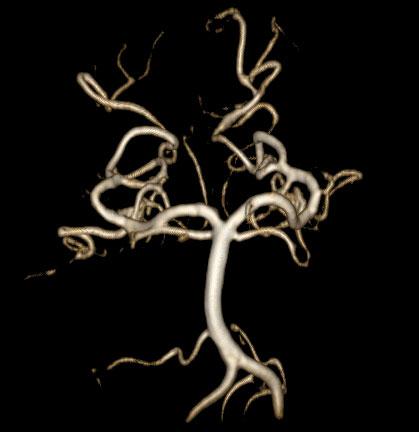 arterie cerebellari superiori (SCA) che originano dal terzo della BA immediatamente al di sotto della dicotomizzazione terminale nelle arterie cerebrali posteriori (PCA) Fig. 5.