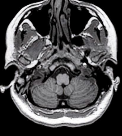 In alto sequenze T1 pesate a elevata risoluzione consentono di apprezzare un buon dettaglio anatomico delle strutture troncoencefaliche e delle circonvoluzioni cerebrali.