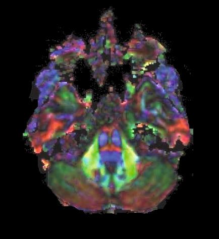 4 Sezione assiale passante per il ponte all altezza del tratto intracisternale dei nervi trigemini.