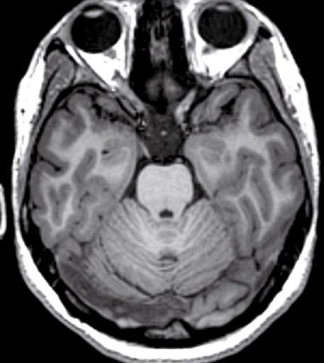 12 1 Anatomia encefalica Nervo ottico Solco temporale medio Giro fusiforme Giro paraippocampale Solco occipitotemporale