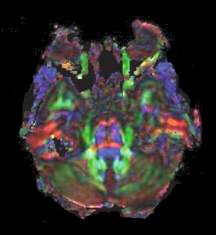 trasverse pontine Lemnisco mediale Peduncolo cerebellare Peduncolo cerebellare Fig. 1.
