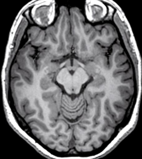 14 1 Anatomia encefalica Solco olfattorio Giro frontomarginale Giro retto Giro orbitario mediale Insula Giro orbitario posteriore Giro subcalloso Ippocampo Scissura laterale di Silvio Solco temporale