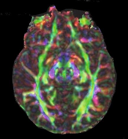 occipitale medio Giro occipitale Corona radiata anteriore Parte pre-commissurale del fornice Capsula esterna Commissura anteriore Colonne del fornice Peduncolo cerebrale Fornice Lemnisco mediale