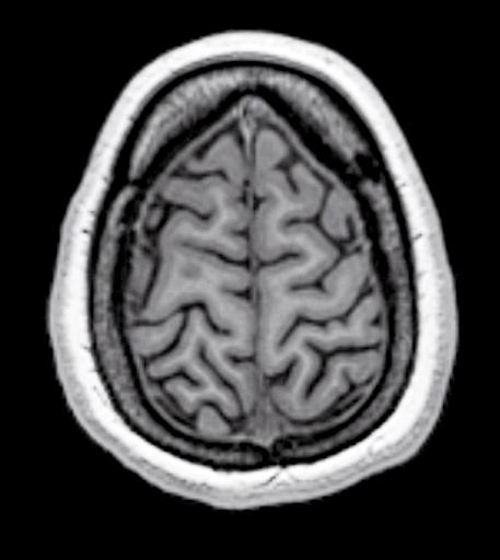 24 1 Anatomia encefalica Giro frontale Solco paracentrale Solco frontale Giro frontale medio Solco precentrale Giro precentrale Solco