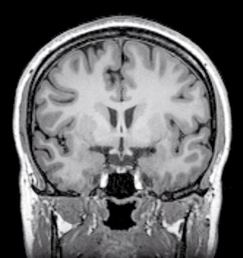 28 1 Anatomia encefalica Seno sagittale Giro frontale Solco frontale Giro frontale medio Solco precentrale Giro precentrale Solco precentrale Giro subcentrale Solco insulare circolare Giro breve dell