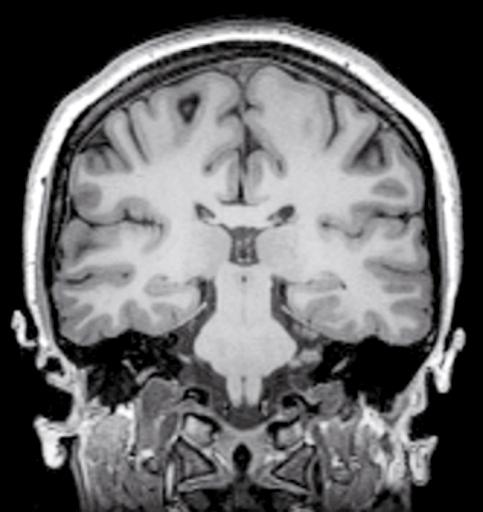 30 1 Anatomia encefalica Solco del cingolo Giro del cingolo Istmo del corpo calloso Ventricolo laterale Fornice Scissura laterale di Silvio Corona radiata Solco temporale Giro paraippocampale Solco