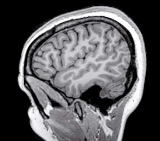 38 1 Anatomia encefalica Giro subcentrale Giro frontale medio Solco frontale Giro frontale - pars opercularis - pars triangularis - pars orbitalis - Solco precentrale Giro precentrale Solco centrale