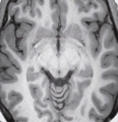 L amigdala è un nucleo di sostanza grigia a forma di mandorla