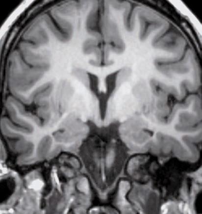 Corpo mammillare Corpo del nucleo caudato Putamen Lamina midollare esterna Globo pallido esterno Lamina midollare interna Ipotalamo Crus cerebri Amigdala Globo pallido